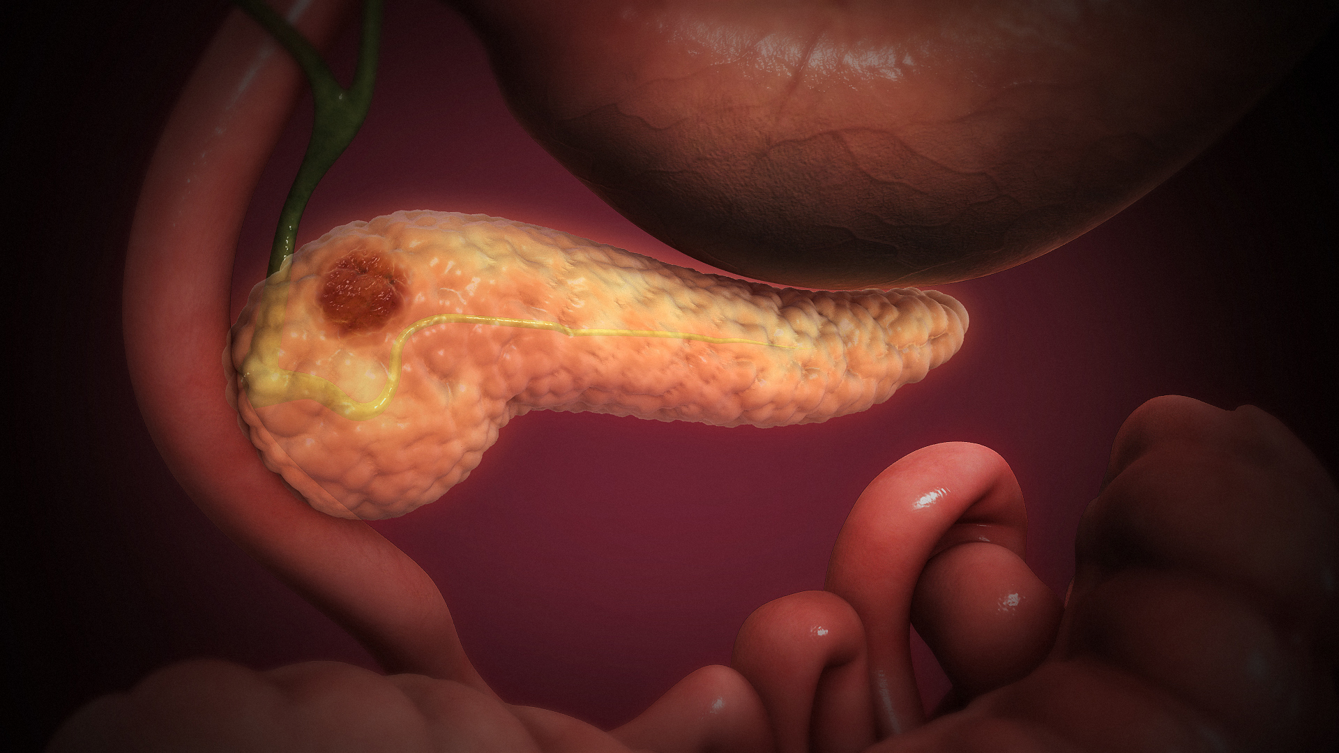 Game-Changer Test for Pancreatic Cancer Detects 85% of Cases for Less Than a Penny!