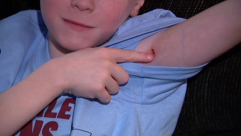 Rabid Fox Attack Leaves Massachusetts Boy Shaken But Unbroken