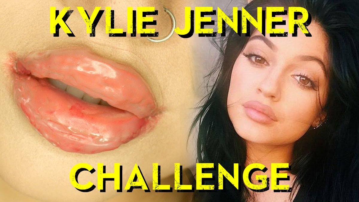 Dr. Dubrow Pleads with Kylie Jenner to Warn Teens Against Early Boob Jobs