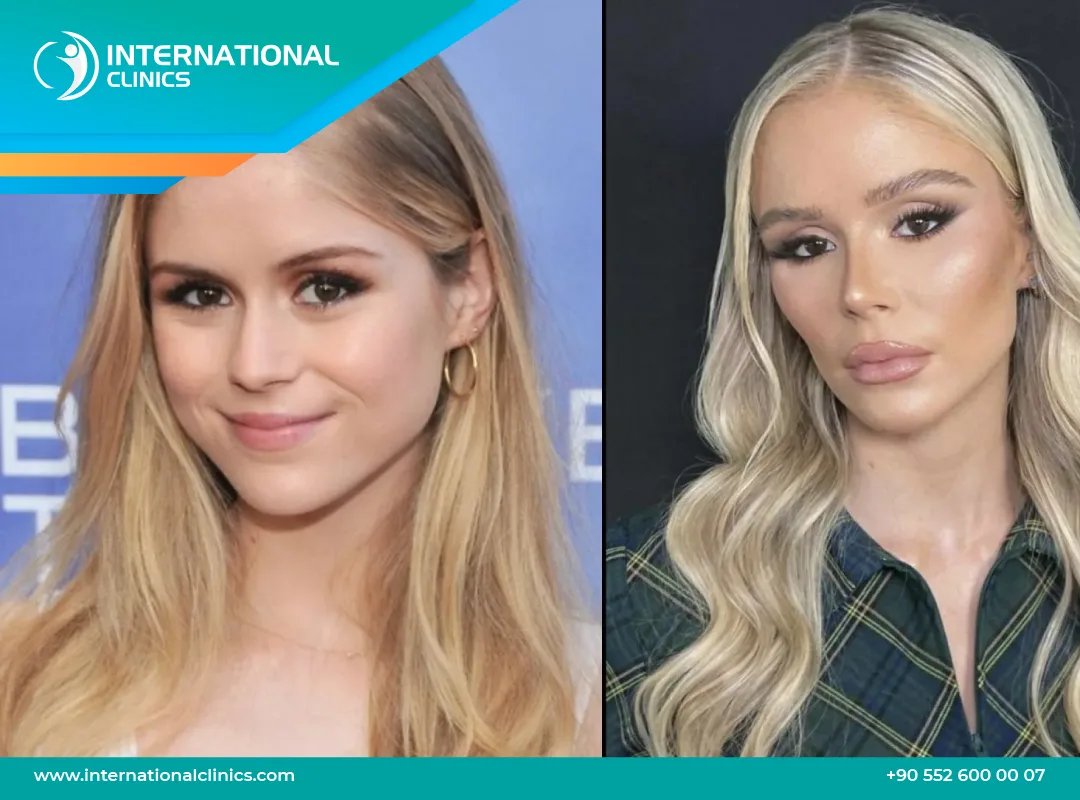 Graves’ Game Changer: Erin Moriarty’s Candid Health Reveal