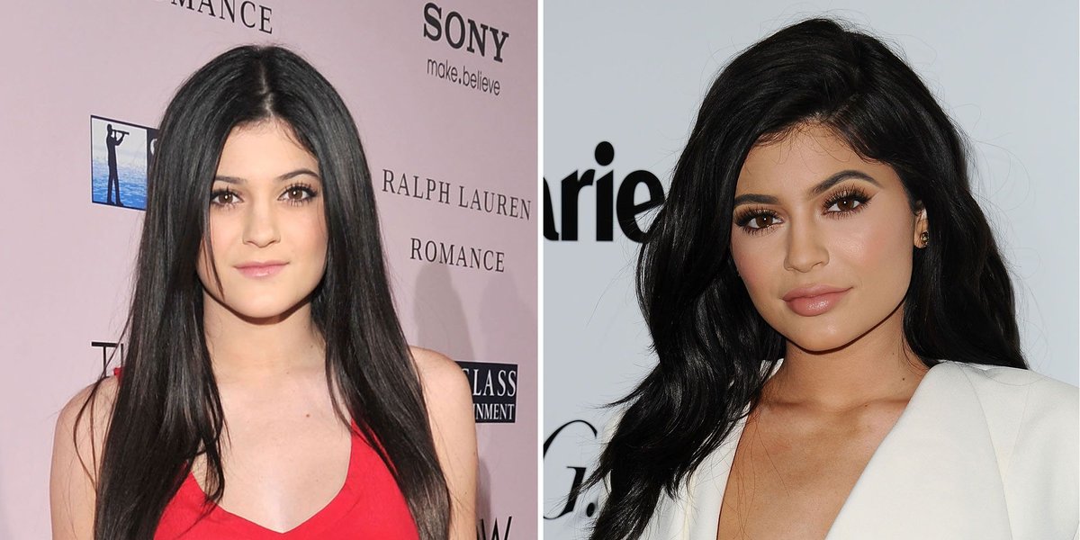 Kris Jenner Unveils Shared Surgeon for 2011 Facelift and Kylie’s Breast Augmentation