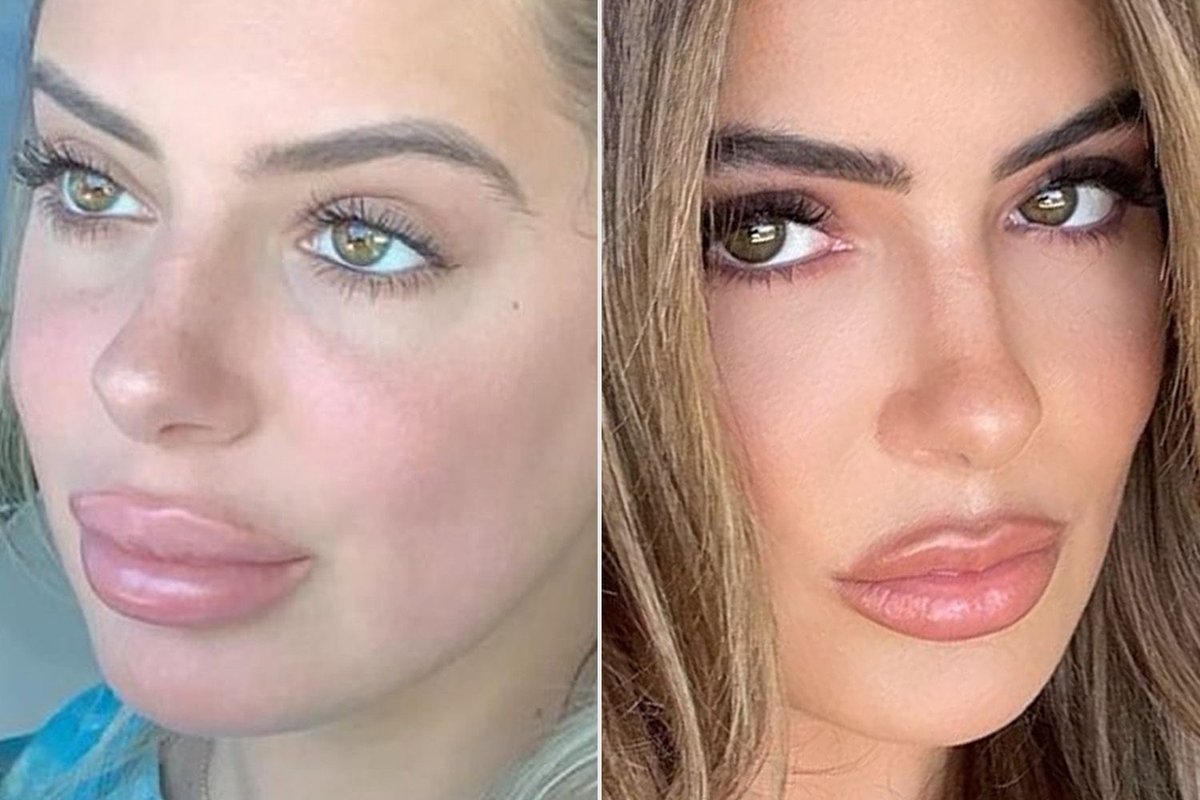 Brielle Biermann Compares Fillers to Diet Coke Habit in Candid Confession