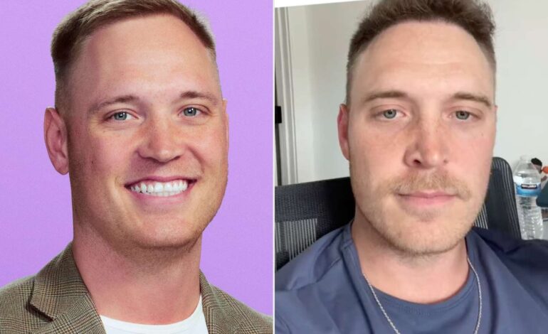 Jimmy Presnell Breaks Down Real Cost of His Chicago Hair Transplant