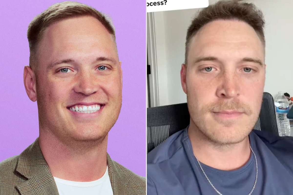 Jimmy Presnell Breaks Down Real Cost of His Chicago Hair Transplant