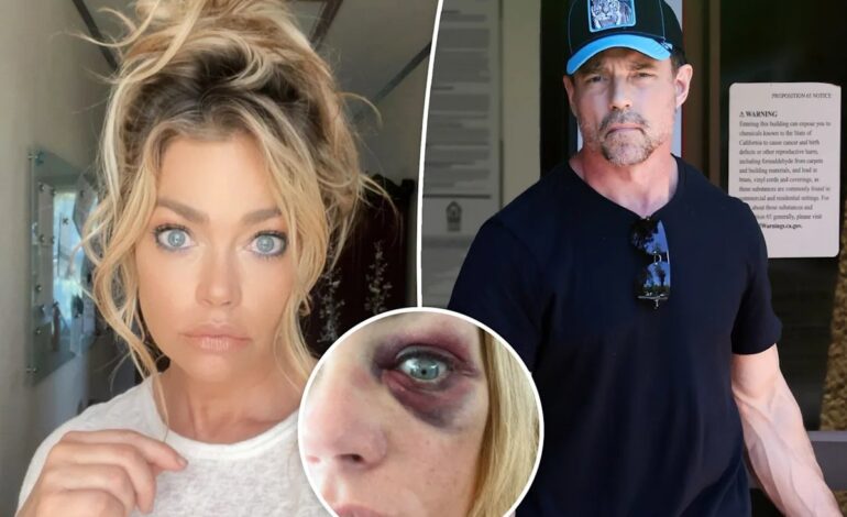Denise Richards Sports Black Eye Amid Restraining Order Drama