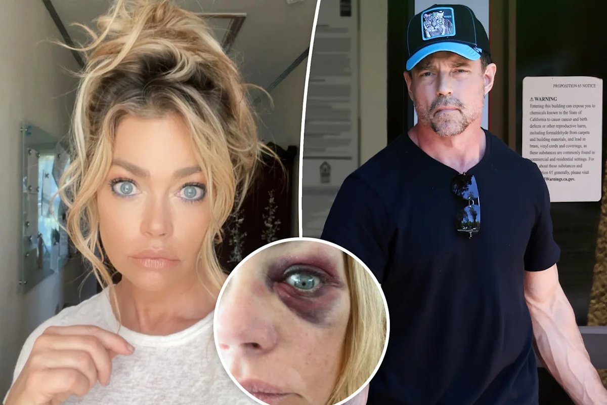 Denise Richards Sports Black Eye Amid Restraining Order Drama