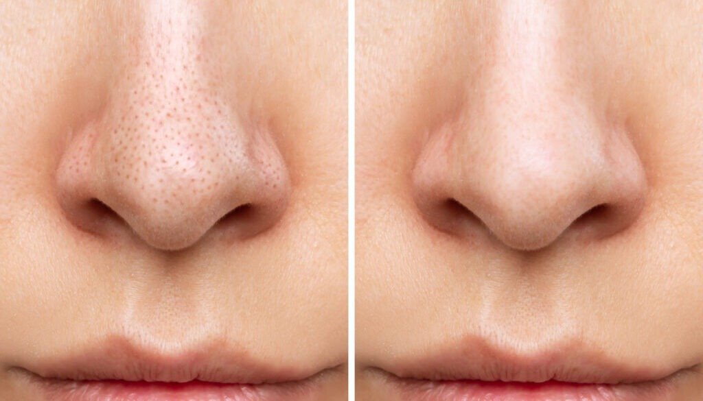 Say Goodbye to Blackheads: The Ultimate Guide to Clear Skin at Home
