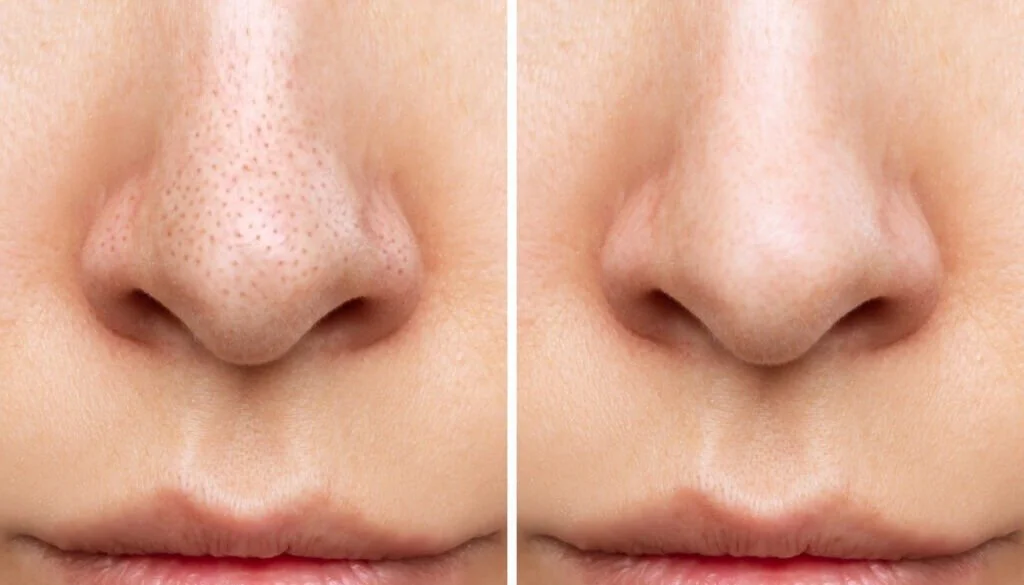 Say Goodbye to Blackheads: The Ultimate Guide to Clear Skin at Home